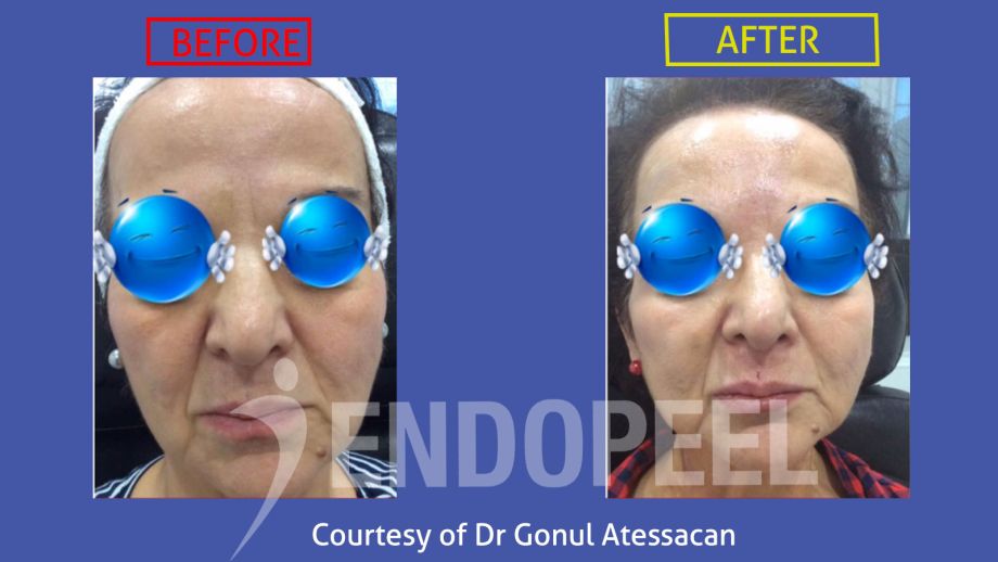 rhinoplasty5_Dr-Gonul-Atessacan.