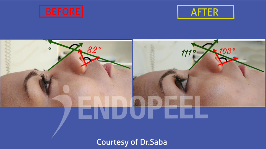 nasal-tip-angles-endopeel