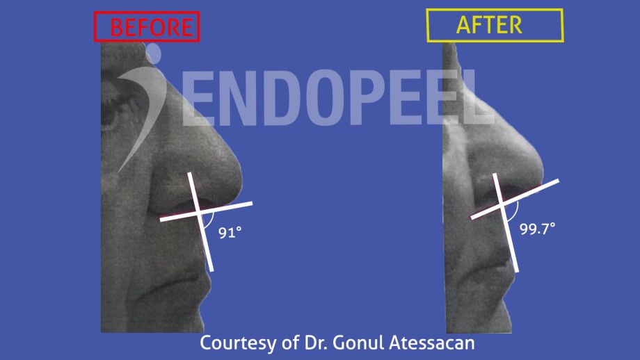 rhinoplasty Dr.Gonul Atessacan (4)-Endopeel