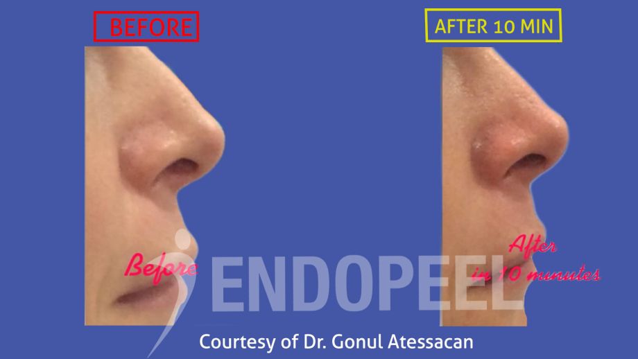 rhinoplasty Dr.Gonul Atessacan-(3) Endopeel