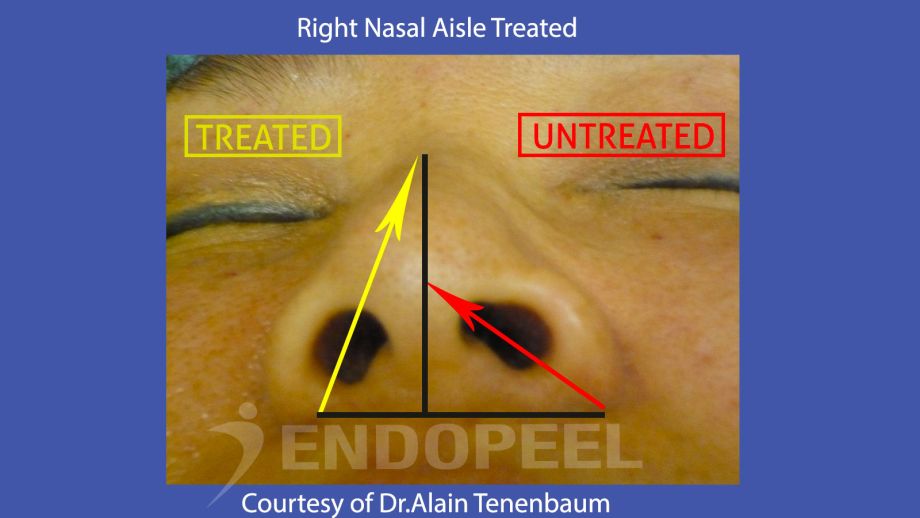nasal-aisles-angles-endopeel