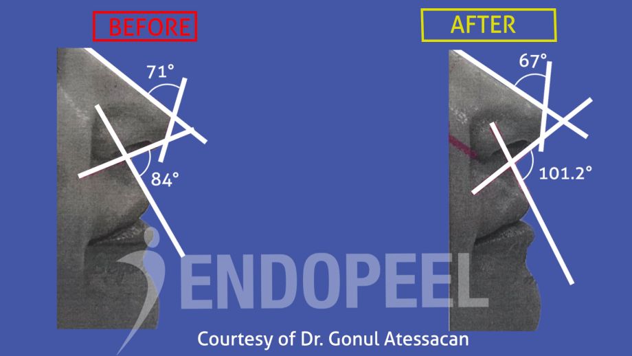 rhinoplasty Dr.Gonul Atessacan (5)- Endopeel