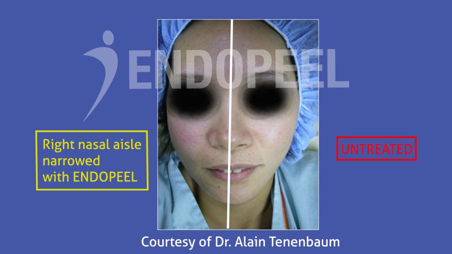 narrowing the nasal aisle on asian female- front-Endopeel