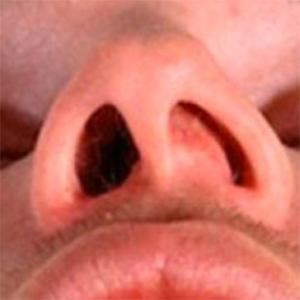 nasal acne