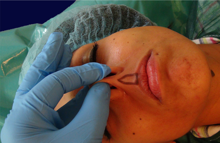 endopeel rhinoplasty step6