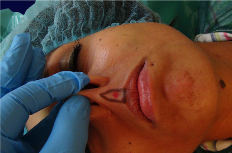 endopeel rhinoplasty step7