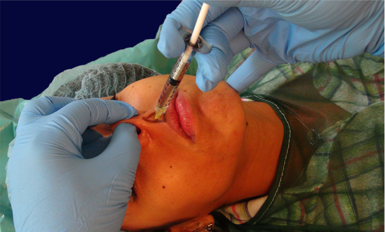 endopeel rhinoplasty step8