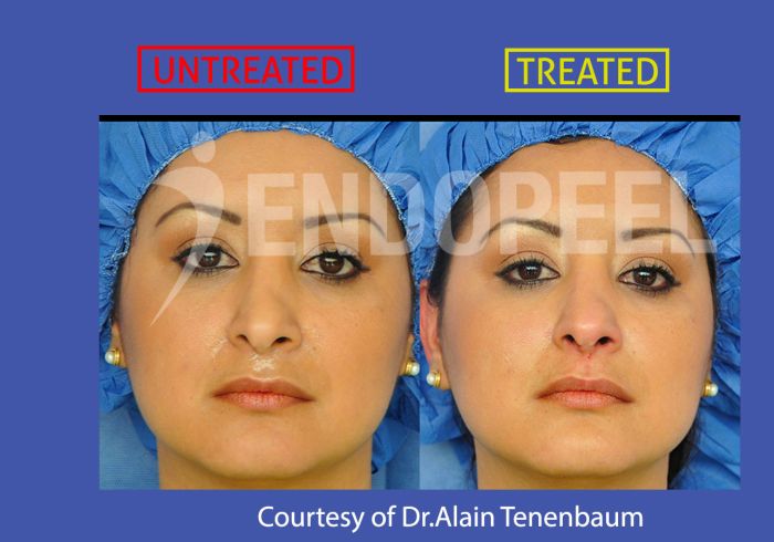rhinoplasty endopeel roxy