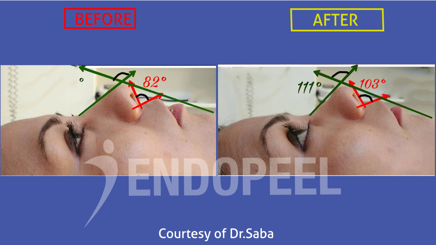 naso labial angle gets wider