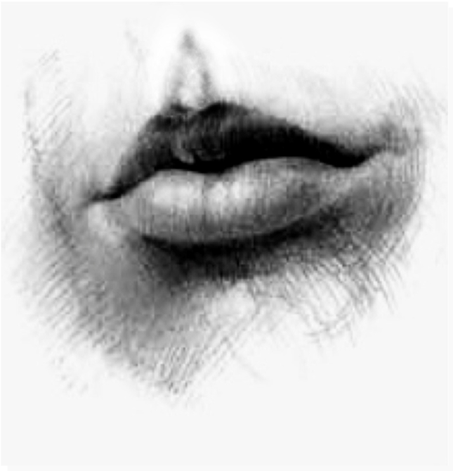 philtrum after endopeel