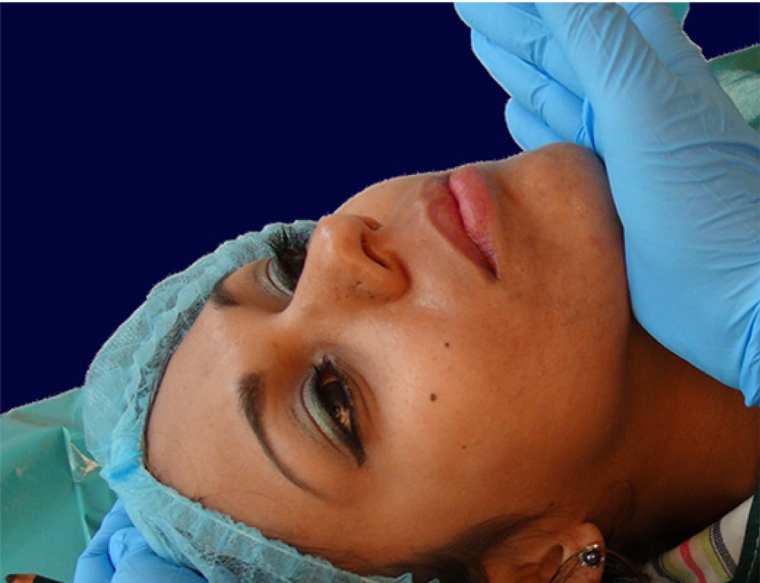 endopeel rhinoplasty step2