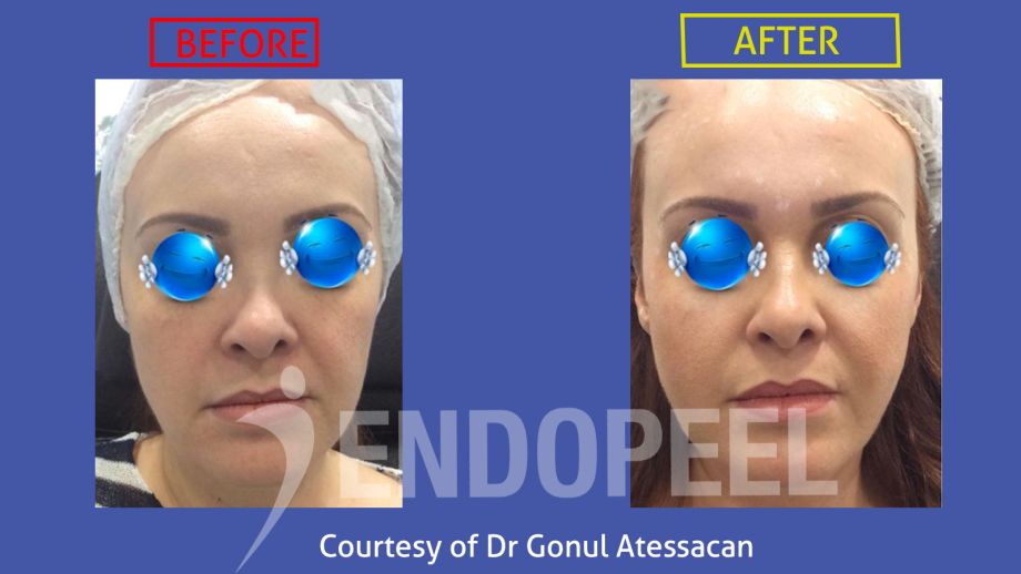rhinoplasty4_Dr-Gonul-Atessacan.