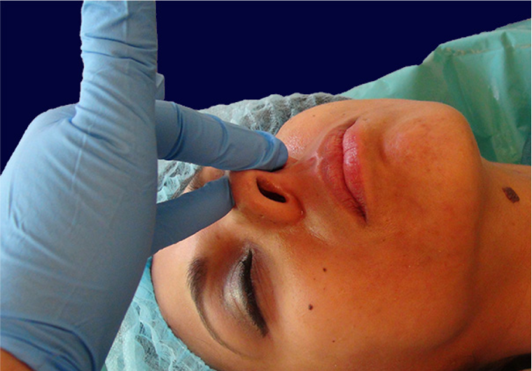 endopeel rhinoplasty step4