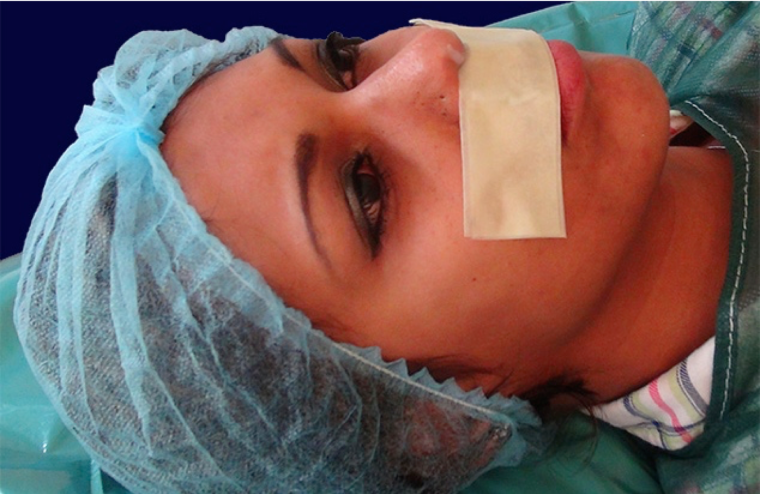 endopeel rhinoplasty step 1