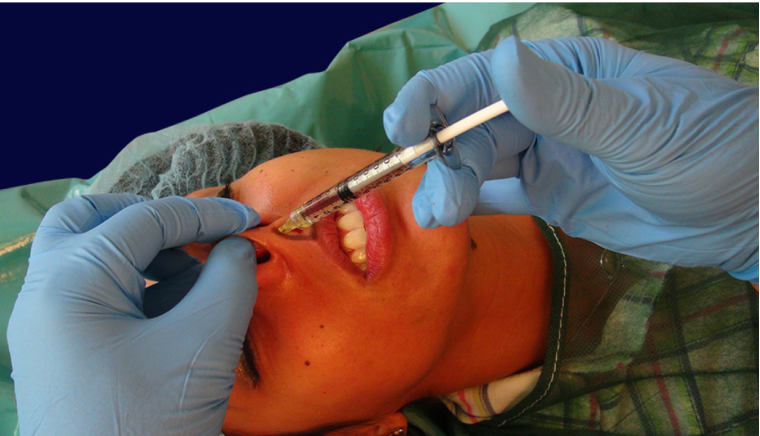 endopeel rhinoplasty step9