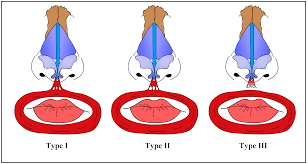 Rohrich Nasal Anatomy