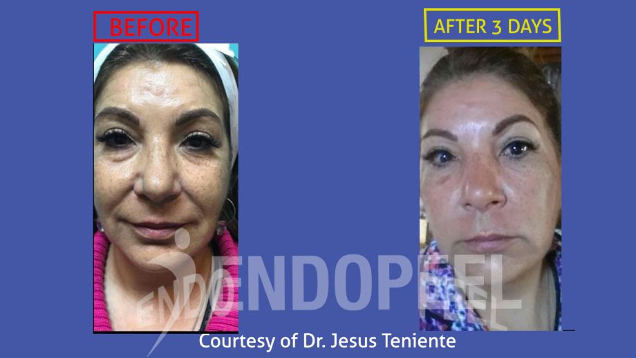 rhinoplasty Dr.Jesus Teniente- Endopeel