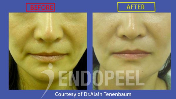 Nasal Tip Endopeel Japanese Woman