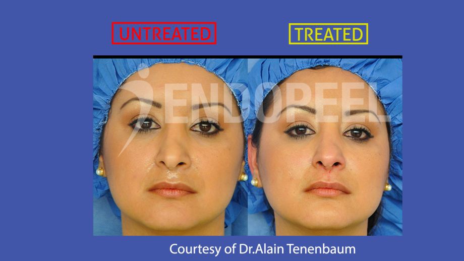 nasal-tip-roxy-endopeel