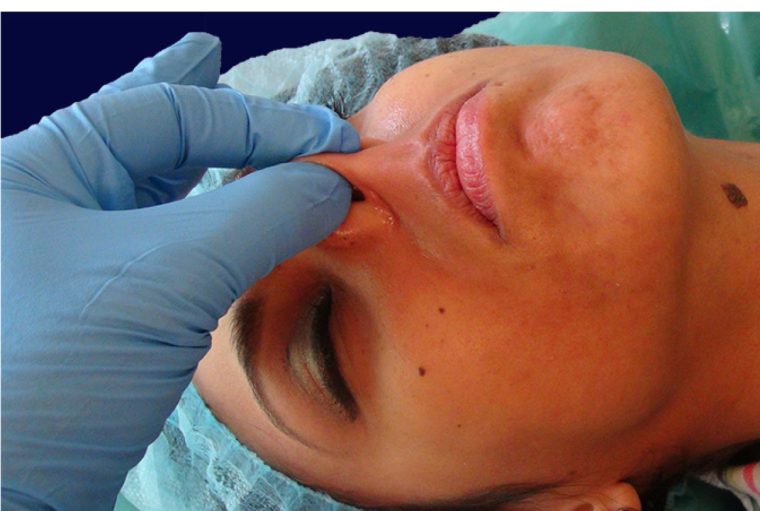 endopeel rhinoplasty step5