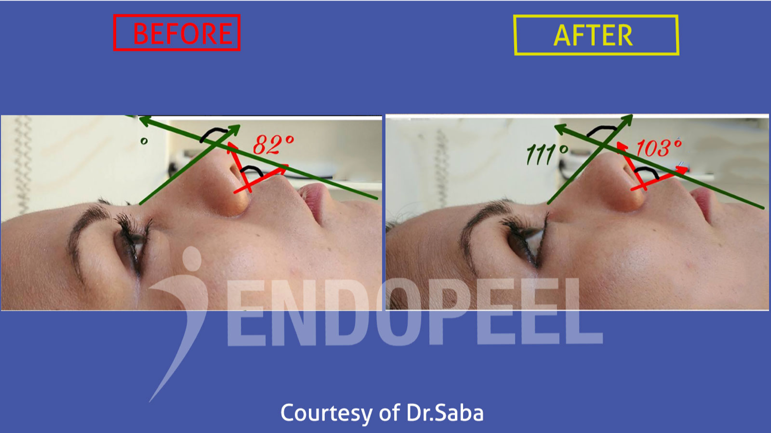 naso labial angle gets wider