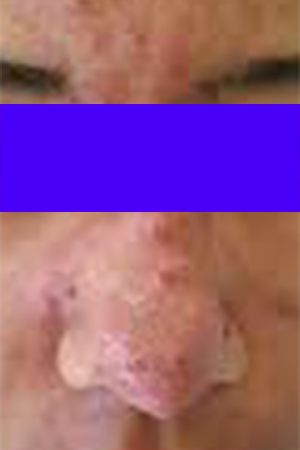 nasal acne